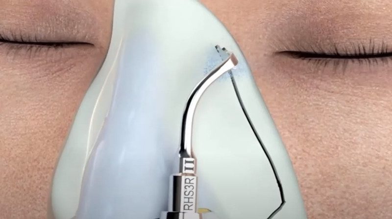 Experiencia rinoplastia ultrasónica dr. Blas García. Fotos antes y después operación de nariz, postoperatorio, opiniones. Cirugía estética.