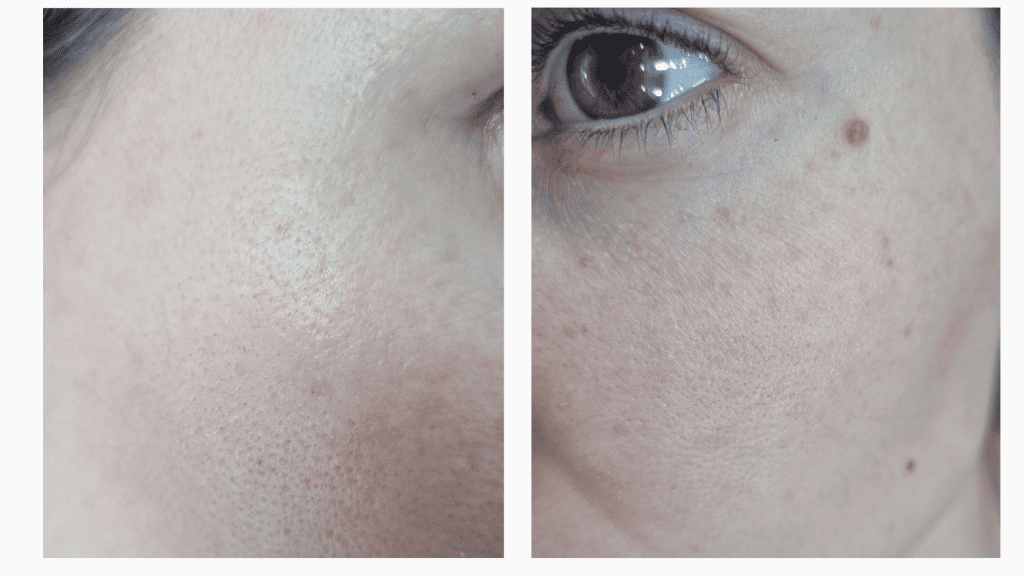 Primera sesión IPL CICATRIZADA Luz Pulsada Intensa IPL manchas solares. Opinión, experiencia, antes y después quitar manchas piel con laser IPL Clínica Ortega y Gasset.