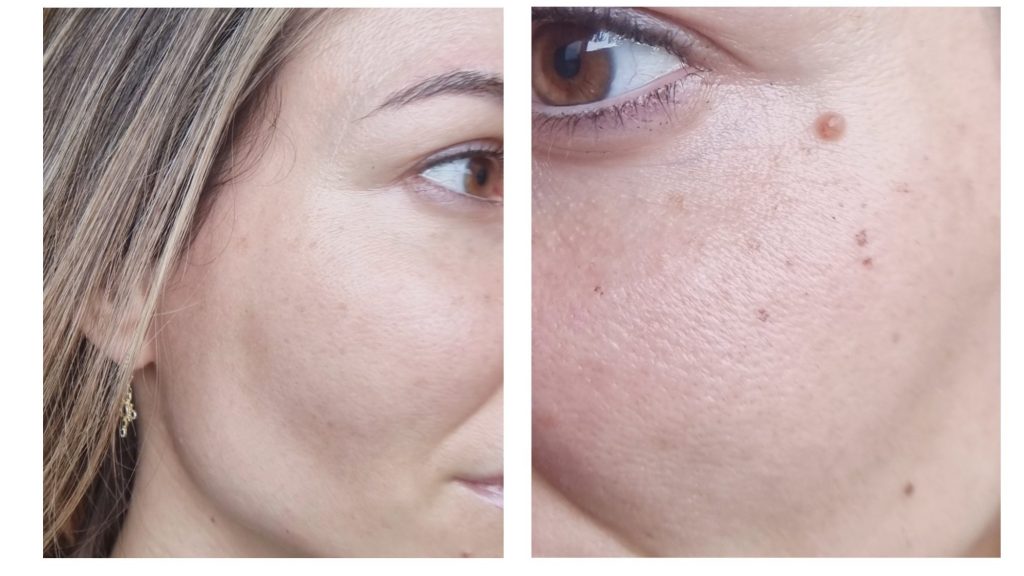 24 horas después de la Primera sesión Luz Pulsada Intensa IPL manchas solares. Opinión, experiencia, antes y después quitar manchas piel con laser IPL Clínica Ortega y Gasset.