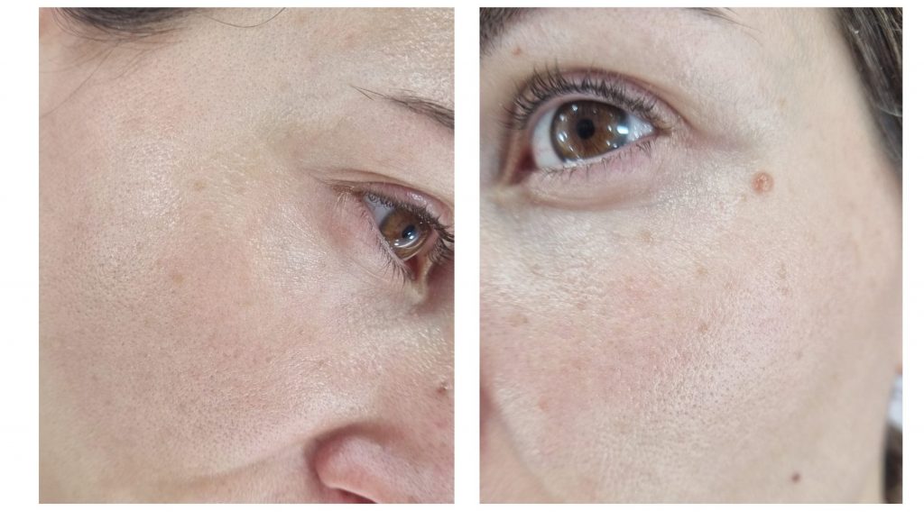 Antes del tratamiento con Luz Pulsada Intensa IPL manchas solares. Opinión, experiencia, antes y después quitar manchas piel con laser IPL Clínica Ortega y Gasset.